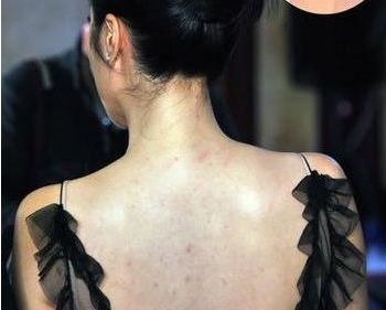 脸上痘痘反反复复毛孔大,痘痘黑头粉刺出油