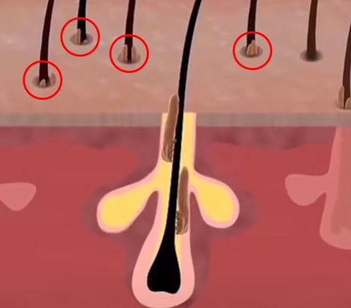 脸上痘痘反反复复毛孔大,痘痘黑头粉刺出油