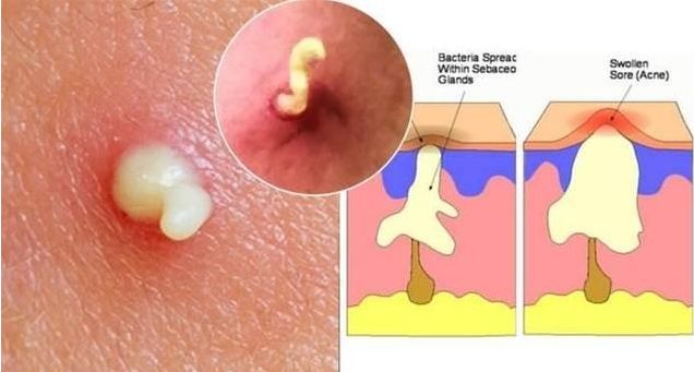 脸上痘痘反反复复毛孔大,痘痘黑头粉刺出油