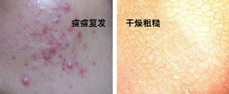 脸上痘痘反反复复毛孔大,痘痘黑头粉刺出油