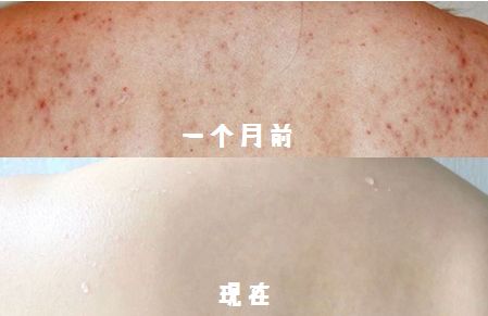 脸上痘痘反反复复毛孔大,痘痘黑头粉刺出油