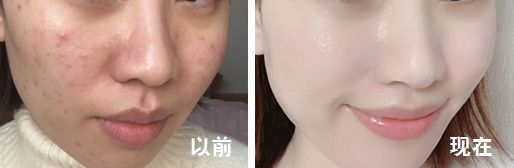 脸上痘痘反反复复毛孔大,痘痘黑头粉刺出油