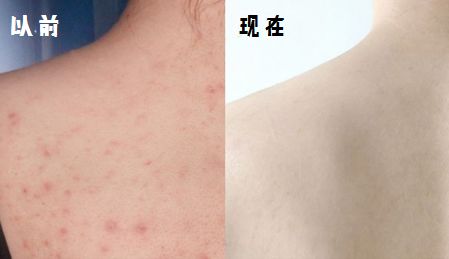 脸上痘痘反反复复毛孔大,痘痘黑头粉刺出油