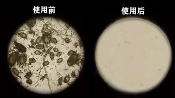 脸上痘痘反反复复毛孔大,痘痘黑头粉刺出油