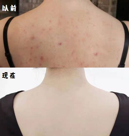 脸上痘痘反反复复毛孔大,痘痘黑头粉刺出油