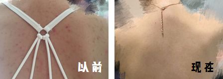 脸上痘痘反反复复毛孔大,痘痘黑头粉刺出油