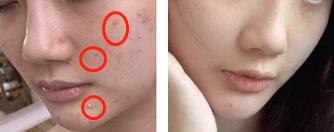 脸上痘痘反反复复毛孔大,痘痘黑头粉刺出油