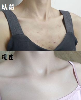 脸上痘痘反反复复毛孔大,痘痘黑头粉刺出油