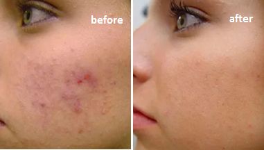 脸上痘痘反反复复毛孔大,痘痘黑头粉刺出油