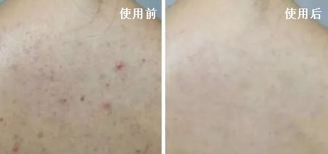 脸上痘痘反反复复毛孔大,痘痘黑头粉刺出油