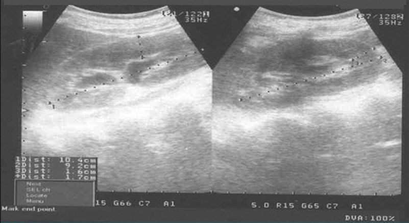 女性腹痛常见疾病,腹痛伴有腹水怎么回事