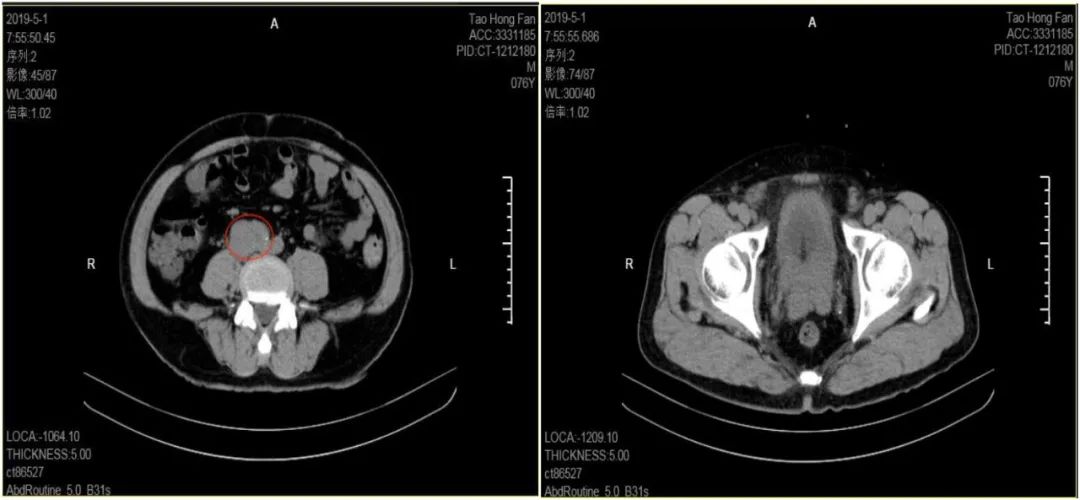 高风险区确诊病例,重症新冠高危人群bmi