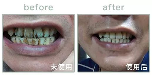 英国人被嘲几十年的黄牙口臭，终于靠它洗白了