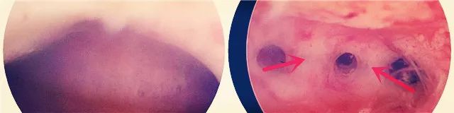 宫腔粘连备孕有妙招,宫腔粘连术后多久可以备孕