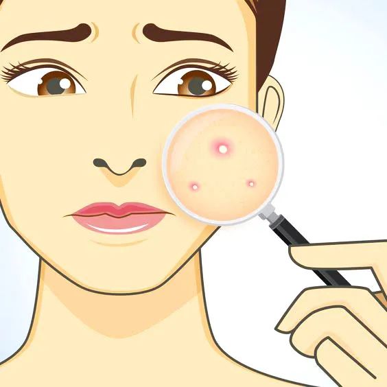 为什么戴上口罩会闷痘,为什么戴口罩就长痘