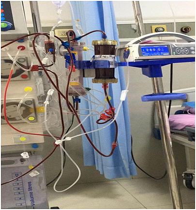 两男子因高脂血症引发胰腺炎医生以血液滤过联合血液灌流治疗已转危为安