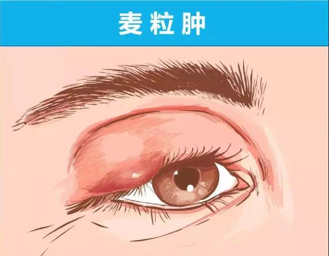 眼睛肿了，到底应该热敷还是冷敷？这次终于解释清楚了