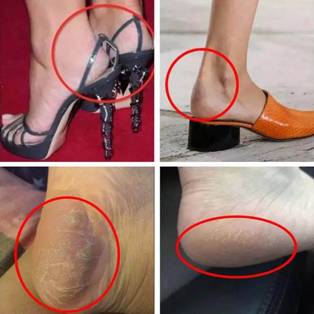 美脚神器磨脚死皮,美脚神器自动磨脚器去死皮老茧