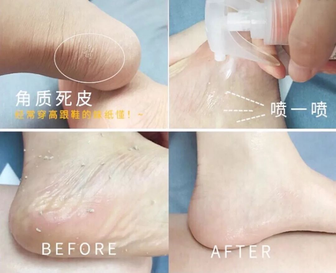 美脚神器磨脚死皮,美脚神器自动磨脚器去死皮老茧