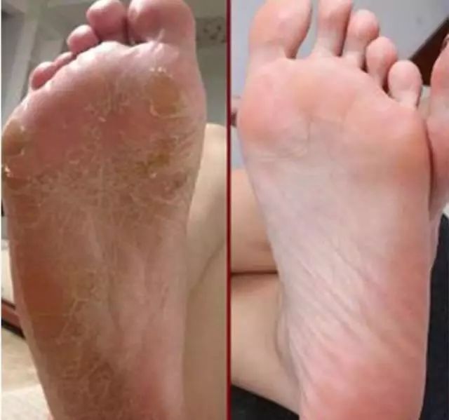 美脚神器磨脚死皮,美脚神器自动磨脚器去死皮老茧