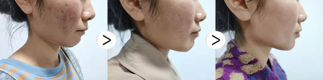 珊苏丽祛痘洁面皂,姗苏丽果酸洁面皂