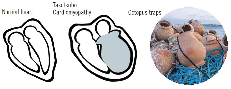 应激性心肌病心电图多久能恢复,应激性心肌病诊断标准