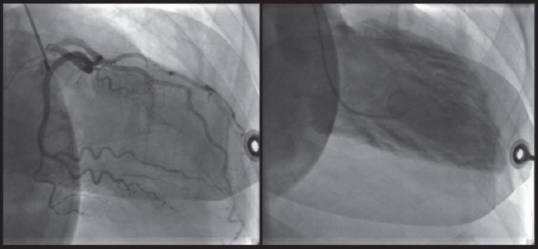 应激性心肌病心电图多久能恢复,应激性心肌病诊断标准