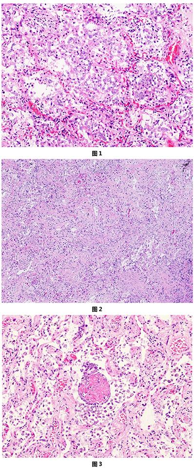 关于新型冠状病毒肺炎诊疗方案,新型冠状病毒肺炎诊疗方案全文