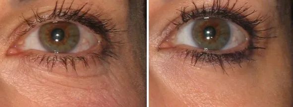 怎样让脸上不长皱纹,脸上长皱纹是缺什么