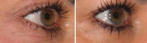 怎样让脸上不长皱纹,脸上长皱纹是缺什么