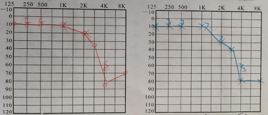 复发性前庭病如何治疗,双侧前庭病治疗