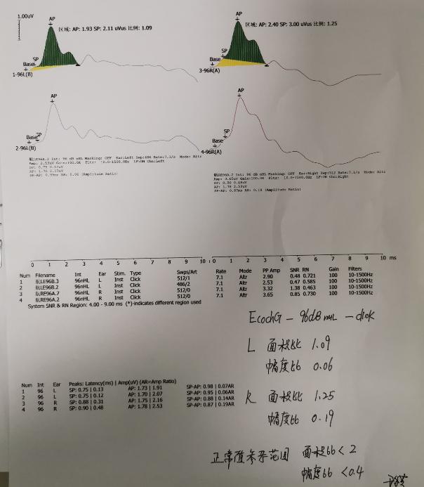 复发性前庭病如何治疗,双侧前庭病治疗