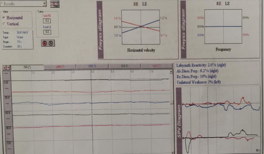复发性前庭病如何治疗,双侧前庭病治疗