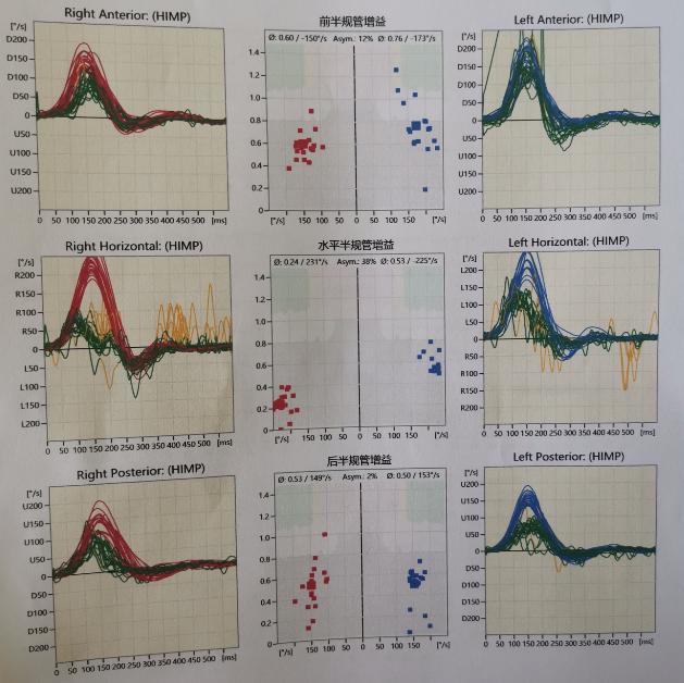 复发性前庭病如何治疗,双侧前庭病治疗