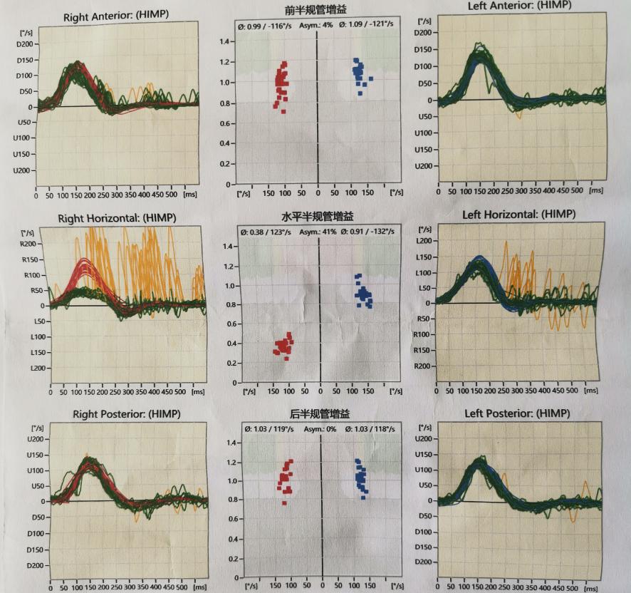 复发性前庭病如何治疗,双侧前庭病治疗