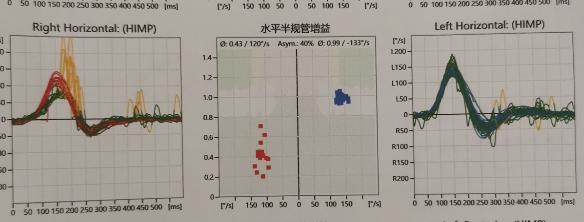 复发性前庭病如何治疗,双侧前庭病治疗