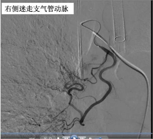 血管畸形破裂咯血,血管破裂咯血