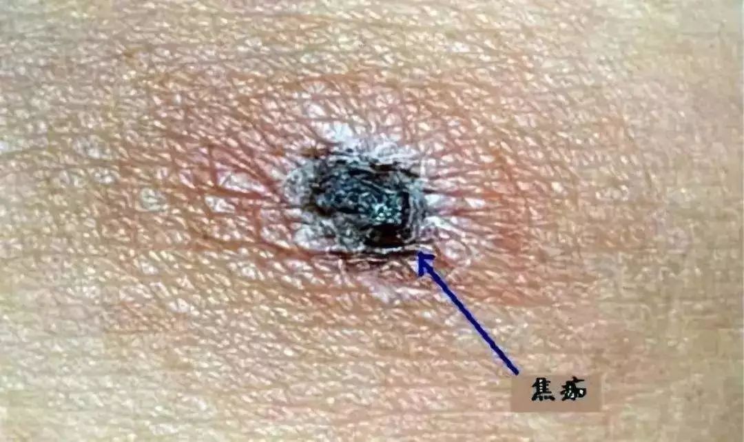 树上为什么那么多小黑虫,树上小黑虫