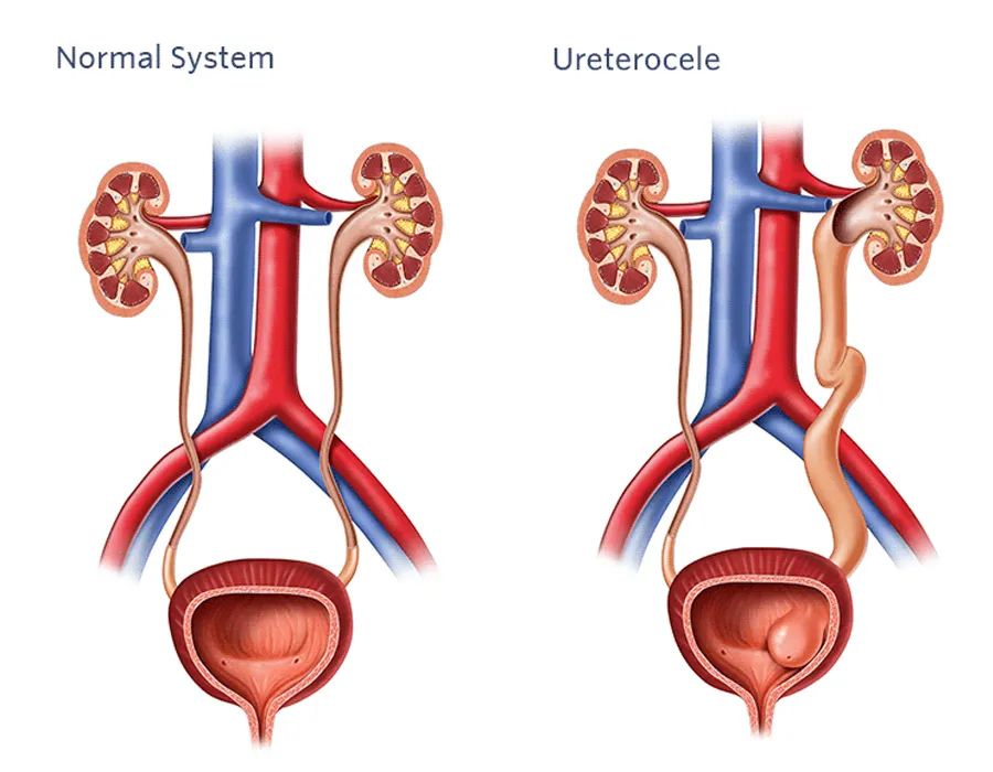 肾积水、排尿困难、脓尿、IVP蛇头征