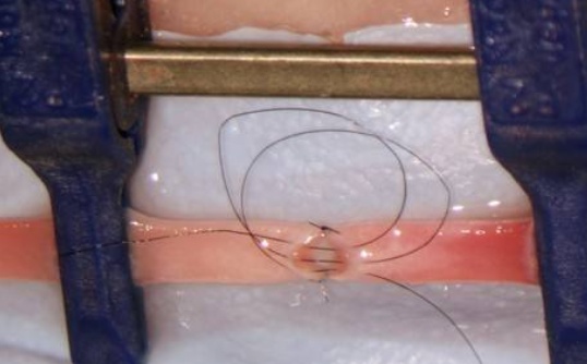 缝合伤口的线留在体内有问题吗,手术缝合线留在皮肤里怎么办