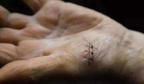 缝合伤口的线留在体内有问题吗,手术缝合线留在皮肤里怎么办