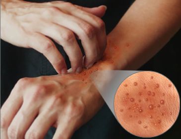 痒？给你一支“不求人”