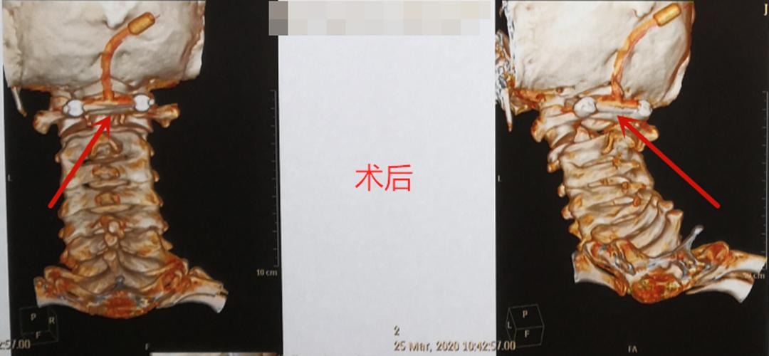 中医院脑病科介入手术,市中医院脑病科