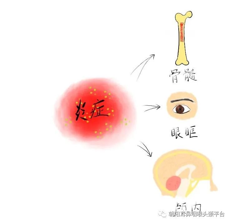 副鼻窦炎头痛怎么办,急性鼻窦炎头痛牙痛吃什么药