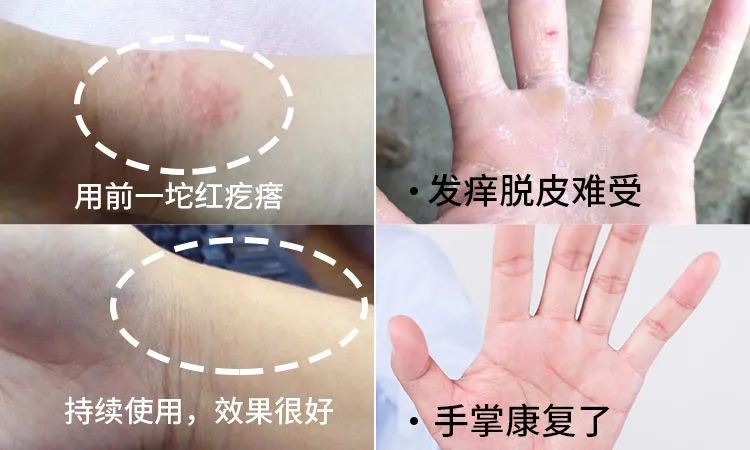 长小水泡很痒用什么中药,皮肤止痒起包用哪个药膏