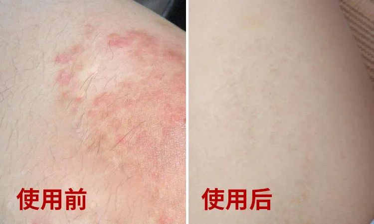 长小水泡很痒用什么中药,皮肤止痒起包用哪个药膏