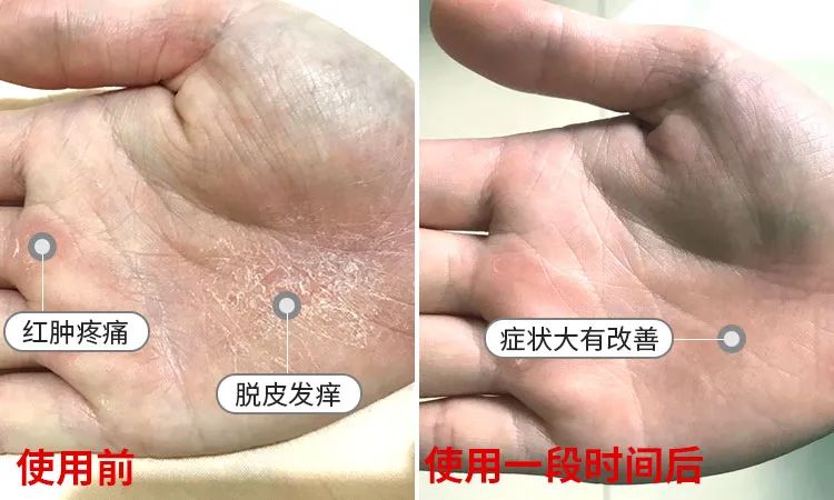 长小水泡很痒用什么中药,皮肤止痒起包用哪个药膏