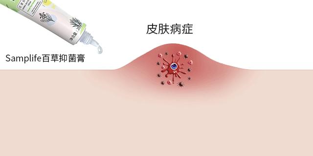 长小水泡很痒用什么中药,皮肤止痒起包用哪个药膏