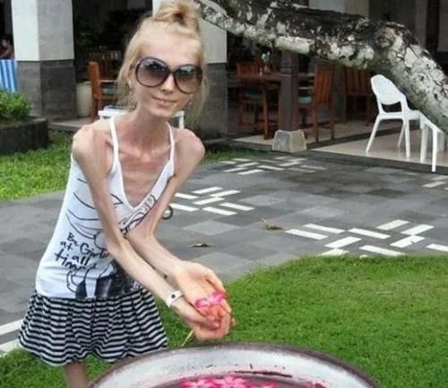 轻断食会得厌食症还是暴食症,厌食症暴食症前期有什么预兆