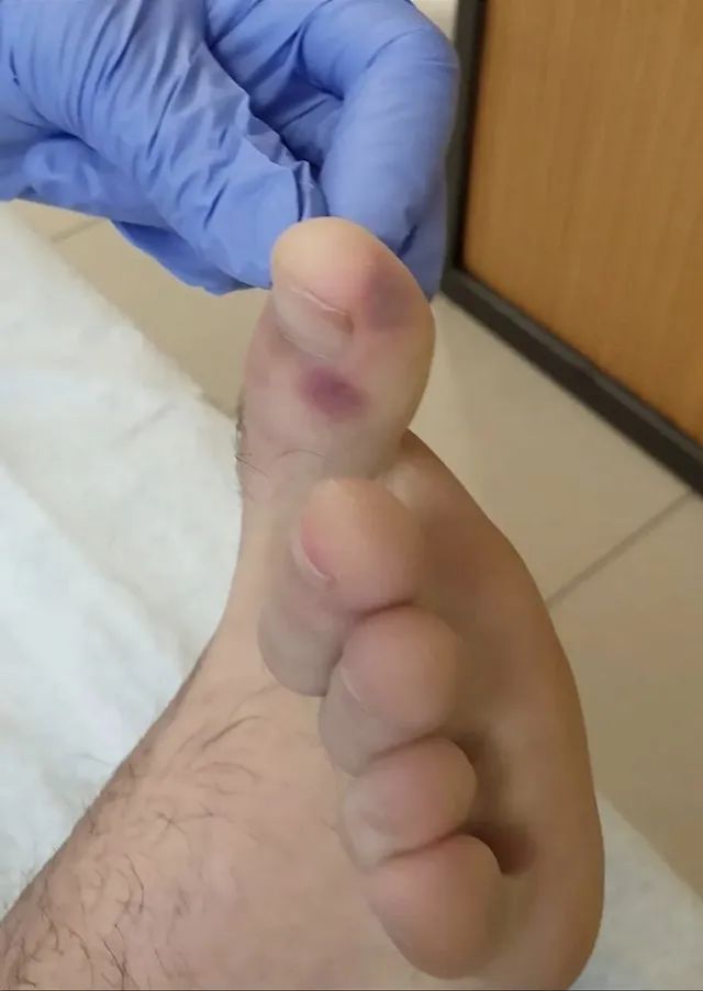 脚上长了一个痘痘医生说是病毒,脚上起痘是怎么了